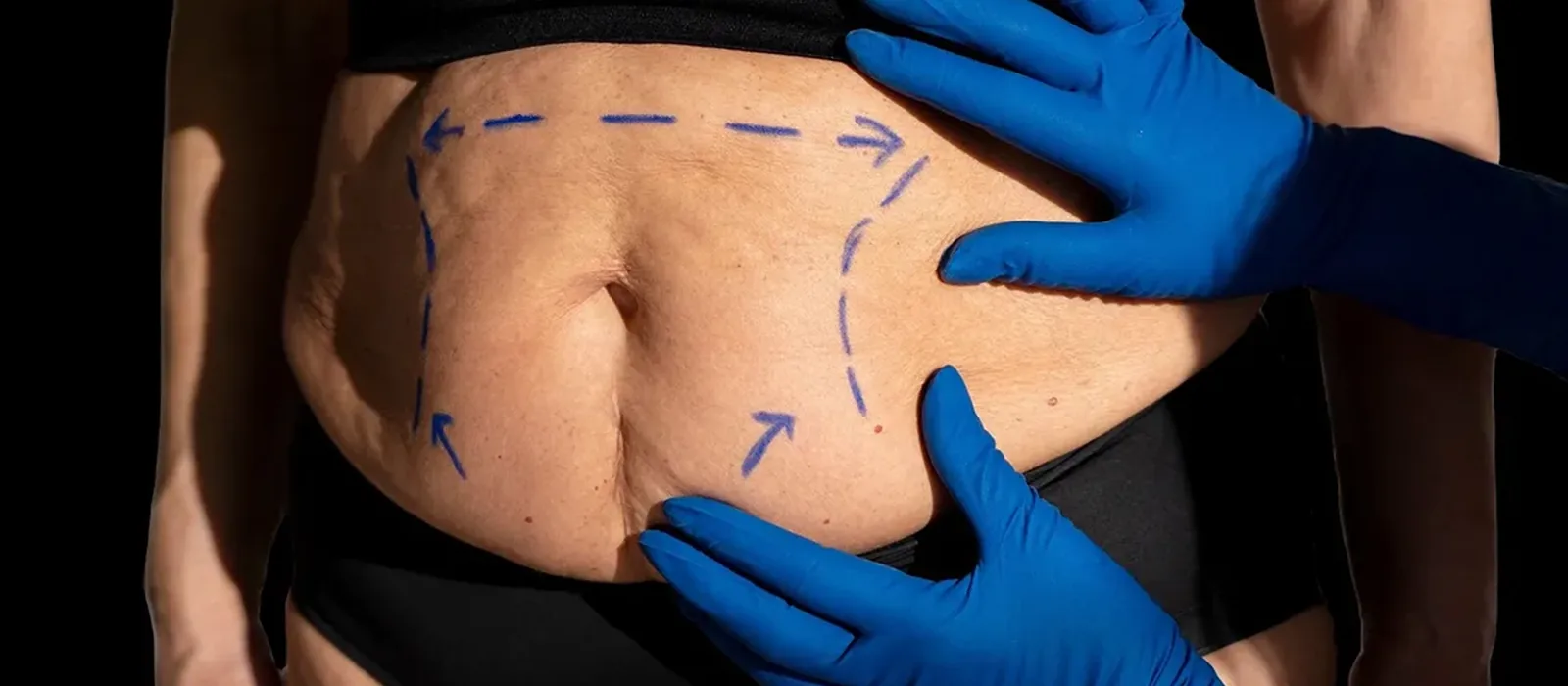 Abdominoplastia: flacidez abdominal tem solu&ccedil;&atilde;o