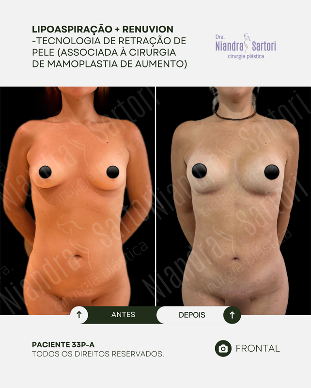 Lipoaspiração + Renuvion, associada à mamoplastia de aumento