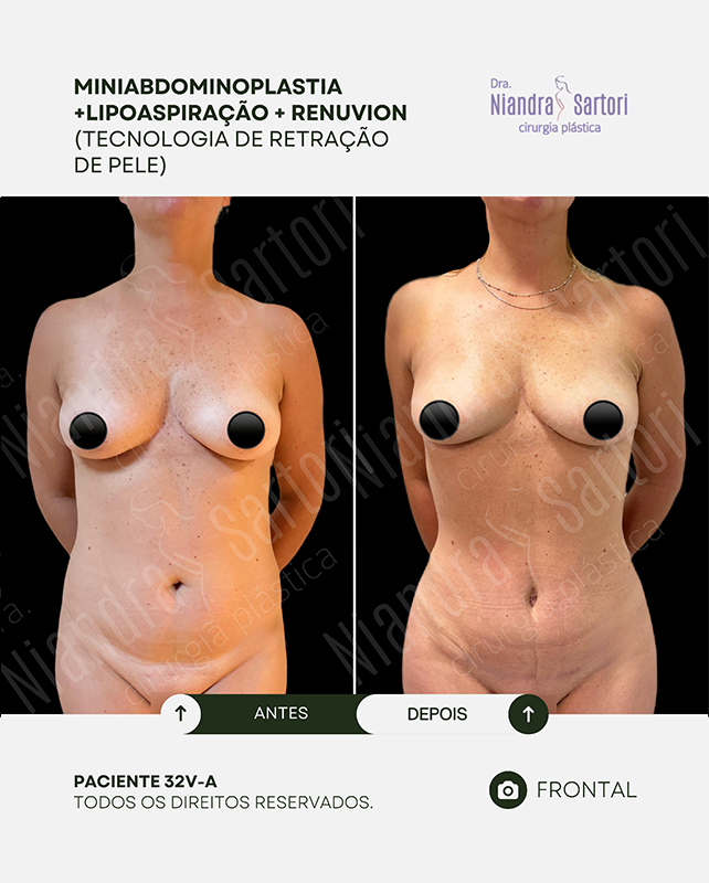 Miniabdominoplastia + lipoaspiração + Renuvion