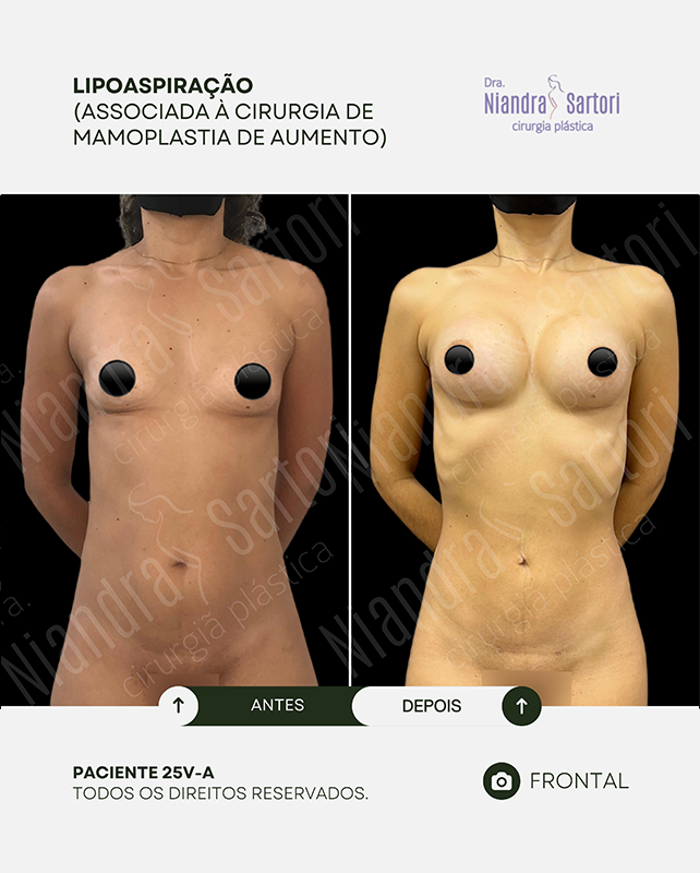 Lipoaspiração, associada à mamoplastia de aumento