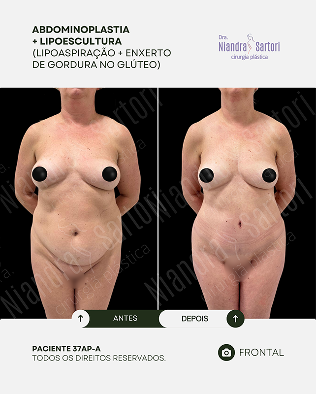 Abdominoplastia + Lipoescultura (Lipoaspiração + enxerto de gordura no glúteo)