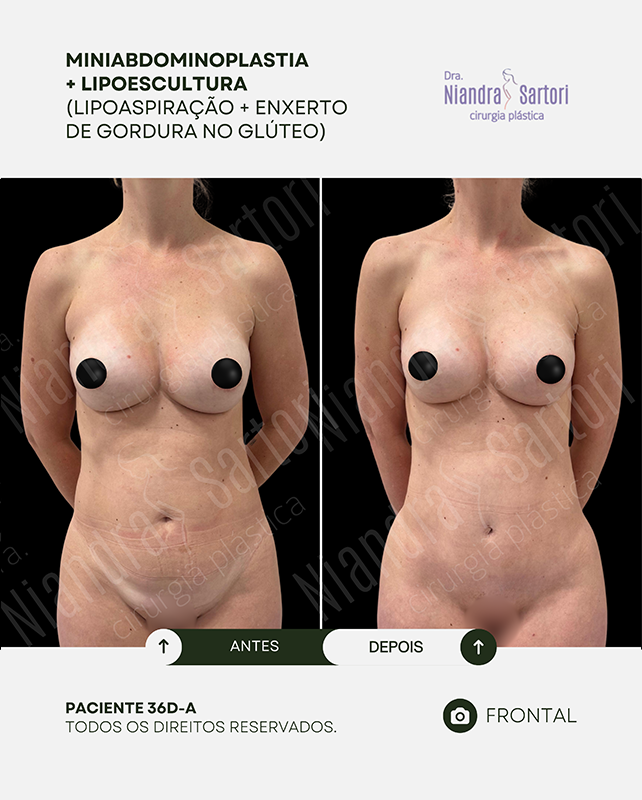 Miniabdominoplastia + Lipoescultura (Lipoaspiração + enxerto de gordura no glúteo)