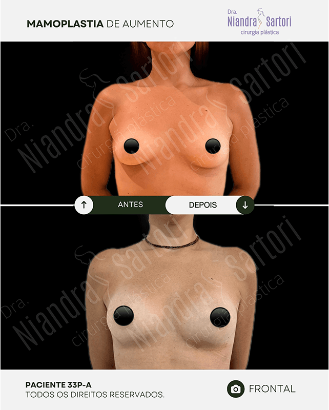 Mamoplastia de aumento