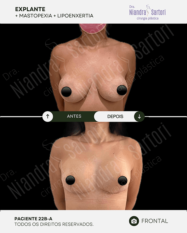 Explante + mastopexia + lipoenxertia