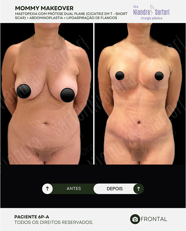 Mastopexia com prótese dual plane, cicatriz em T (short scar) + abdominoplastia + lipoaspiração de flancos