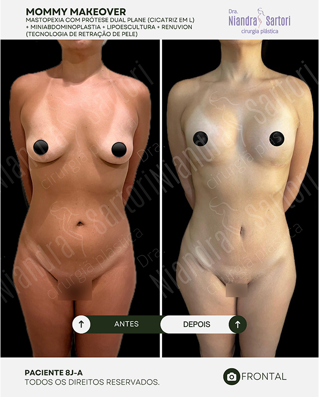 Mastopexia com prótese dual plane, cicatriz em L + miniabdominoplastia + lipoescultura + Renuvion
