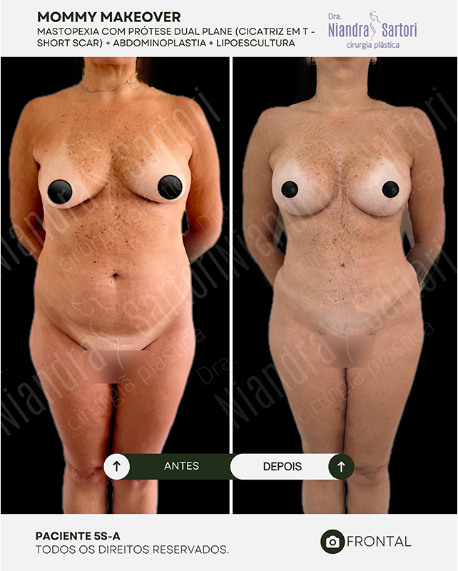Mastopexia com prótese dual plane, cicatriz em T (short scar) + abdominoplastia + lipoescultura