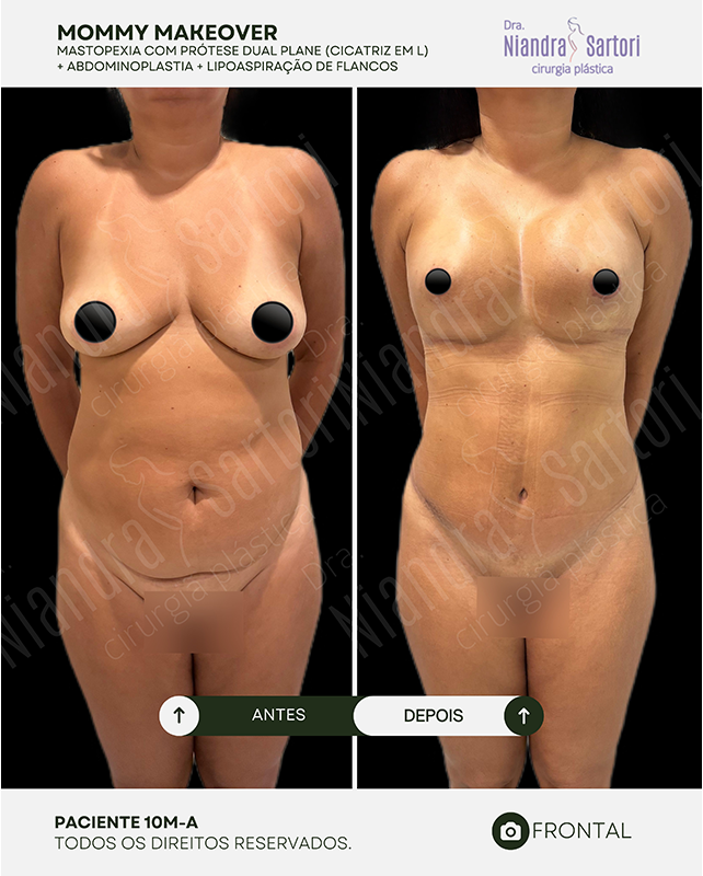 Mastopexia com prótese dual plane, cicatriz em L + abdominoplastia + lipoaspiração de flancos