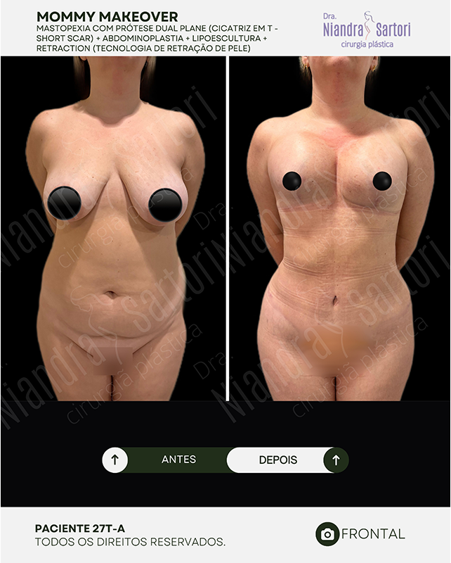 Mastopexia com prótese dual plane, cicatriz em T (short scar) + abdominoplastia + lipoescultura + Retraction