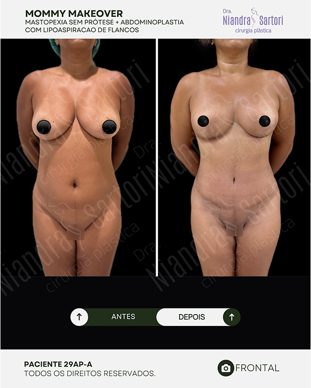Mastopexia sem prótese + abdominoplastia com lipoaspiração de flancos