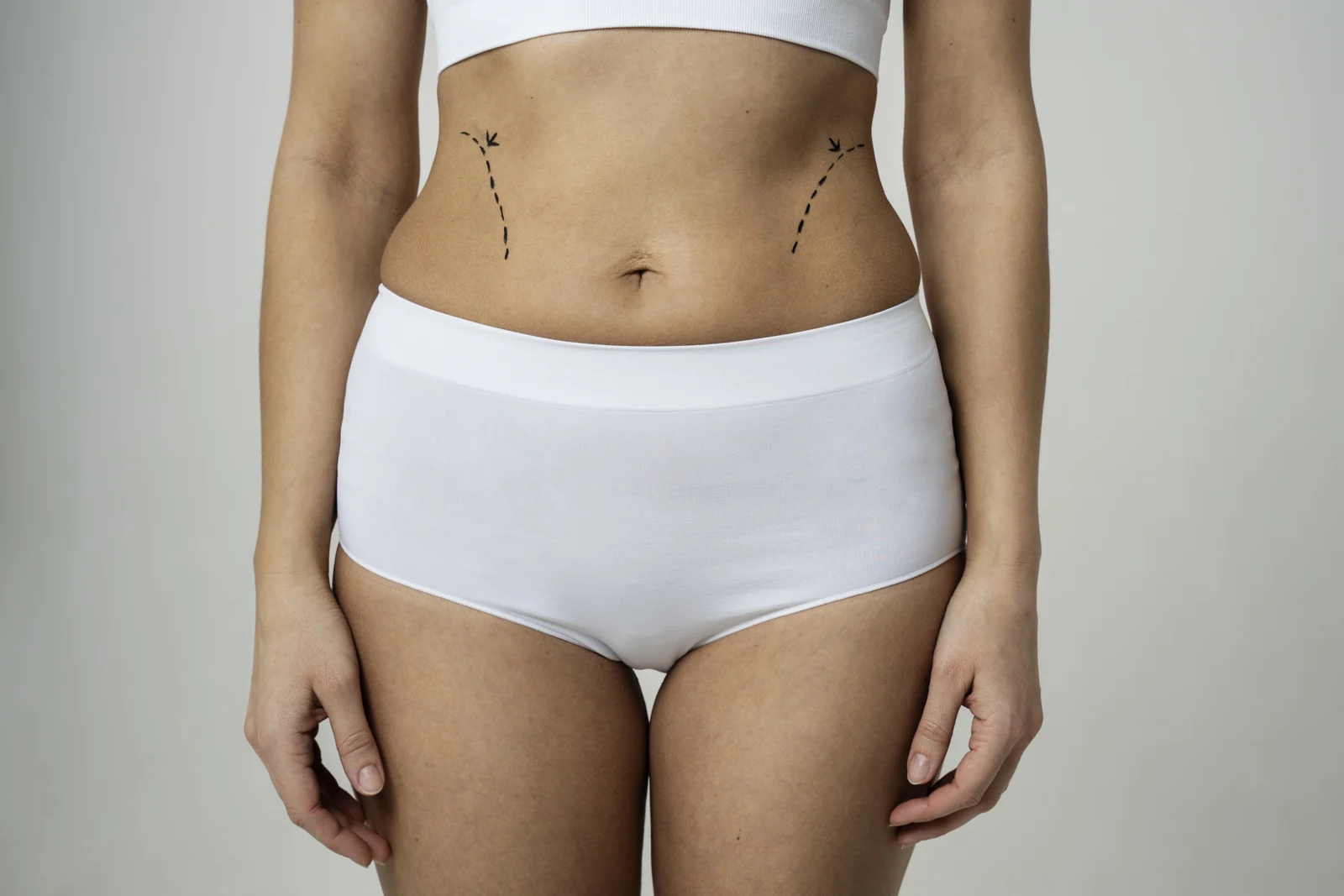 Referência do contorno abdominal e dos flancos para planejamento.